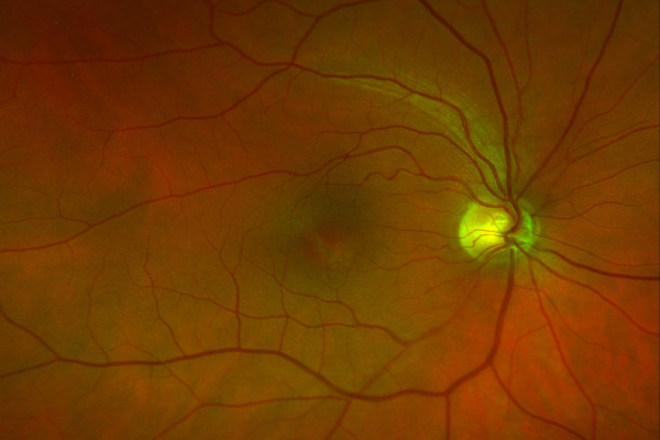 Pre and Post-Surgical Eye Care